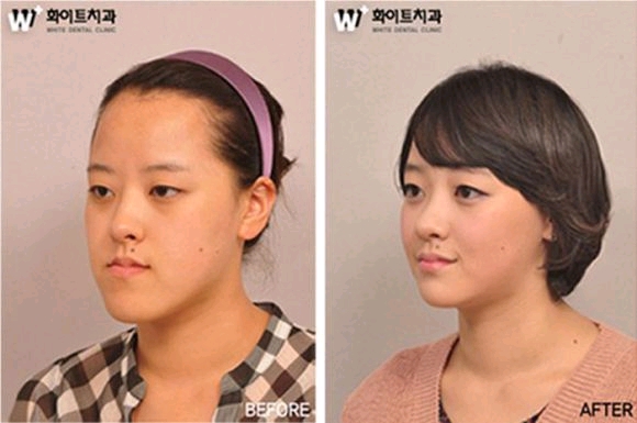 �؍��̐��`�r�t�H�[�E�A�t�^�[